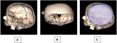 Posttraumatic hydrocephalus as a complication of decompressive craniectomy–same old story, new perspectives